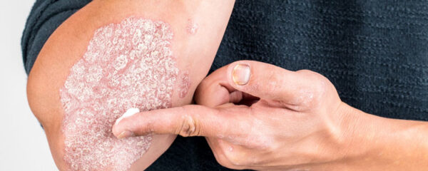 Traitement contre le psoriasis