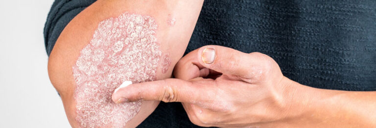 Traitement contre le psoriasis