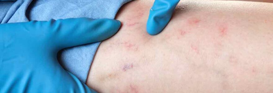 pathologies veineuses